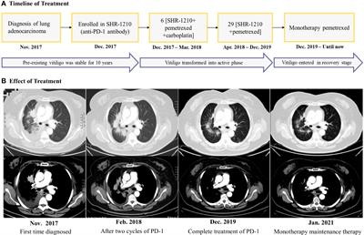 The time window for the reversal of depigmentation from aggravation to recovery in a non-small-cell lung cancer patient with pre-existing vitiligo using anti-programmed cell death-1 therapy: A case report